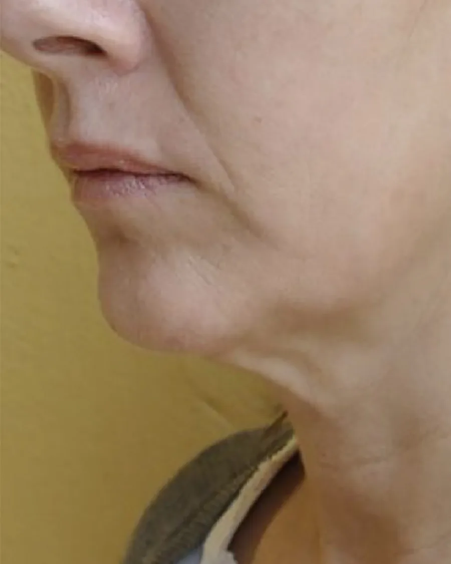 The jawline and neck of a woman in profile, before treatment