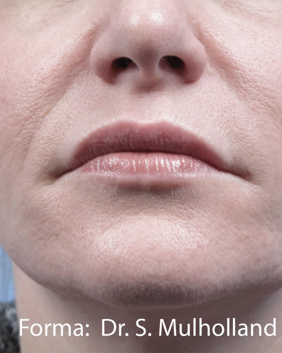 The lower face of a woman, after treatment
