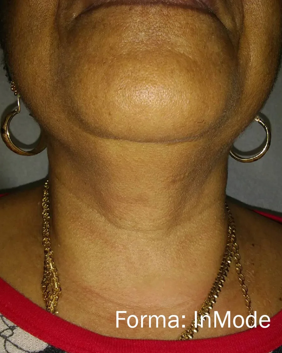 The neck of a woman, after treatment