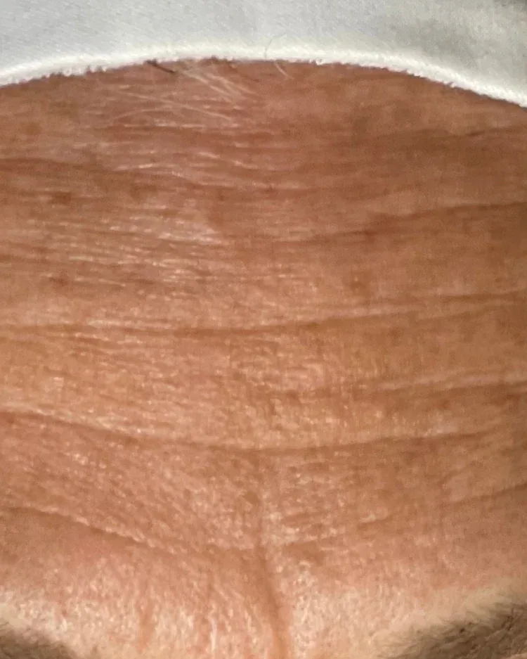 A forehead with fine lines, before treatment