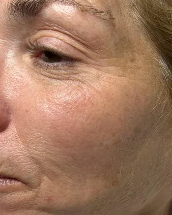 The cheek and eye area of a woman with fine lines, before treatment
