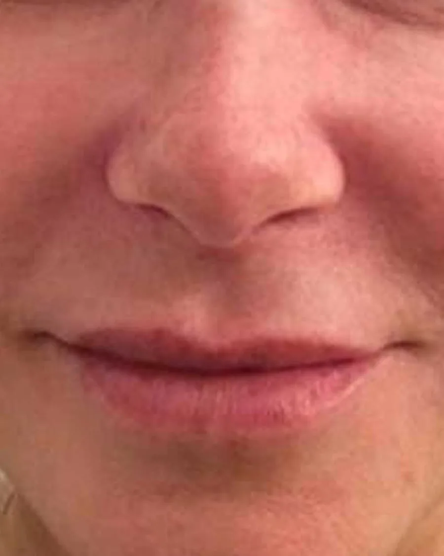The lower face of a woman with freckles across both cheeks, after treatment