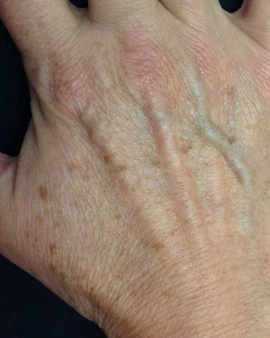 The back of a woman's hand with sun spots, before treatment