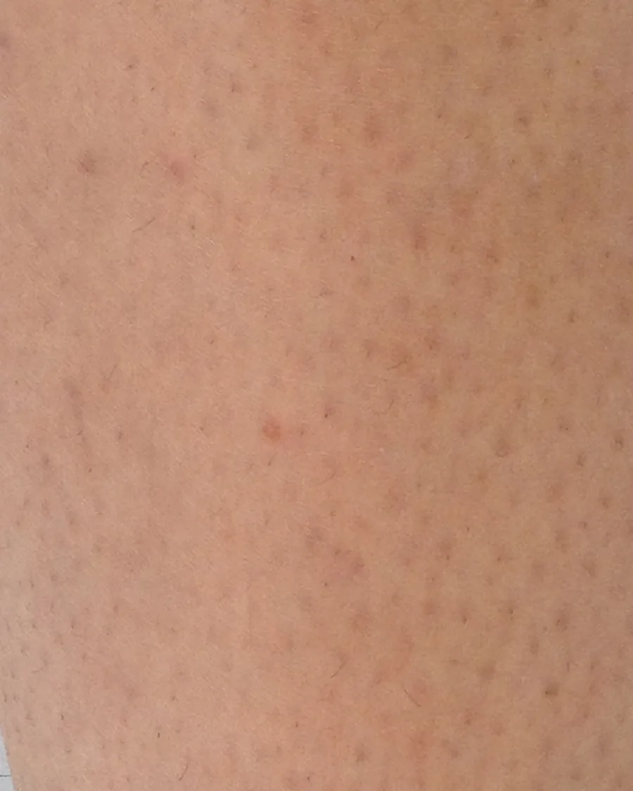 The calf of a guest, after treatment