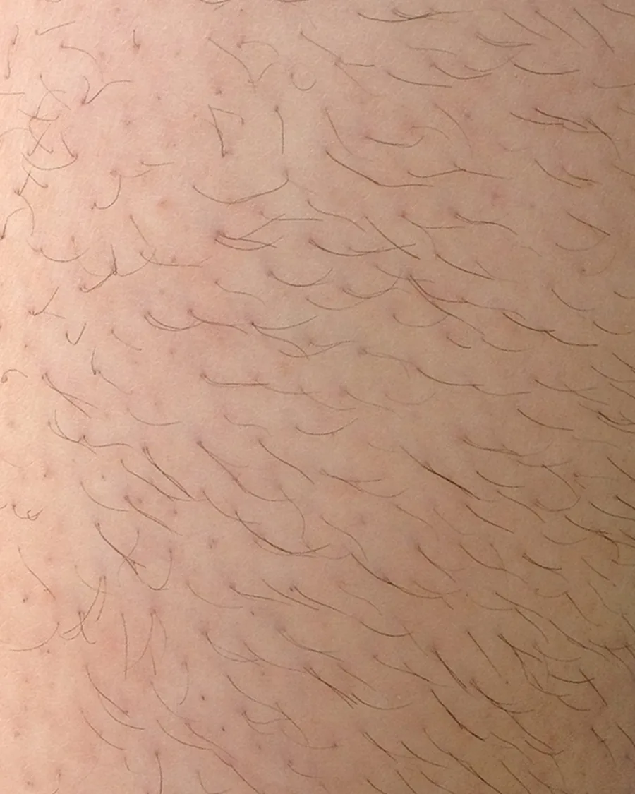 The calf of a guest, before treatment