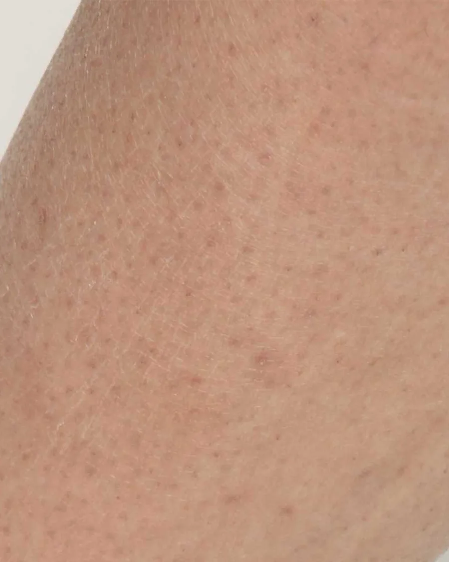 The lower leg of a guest, after treatment
