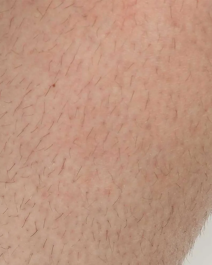 The lower leg of a guest, before treatment