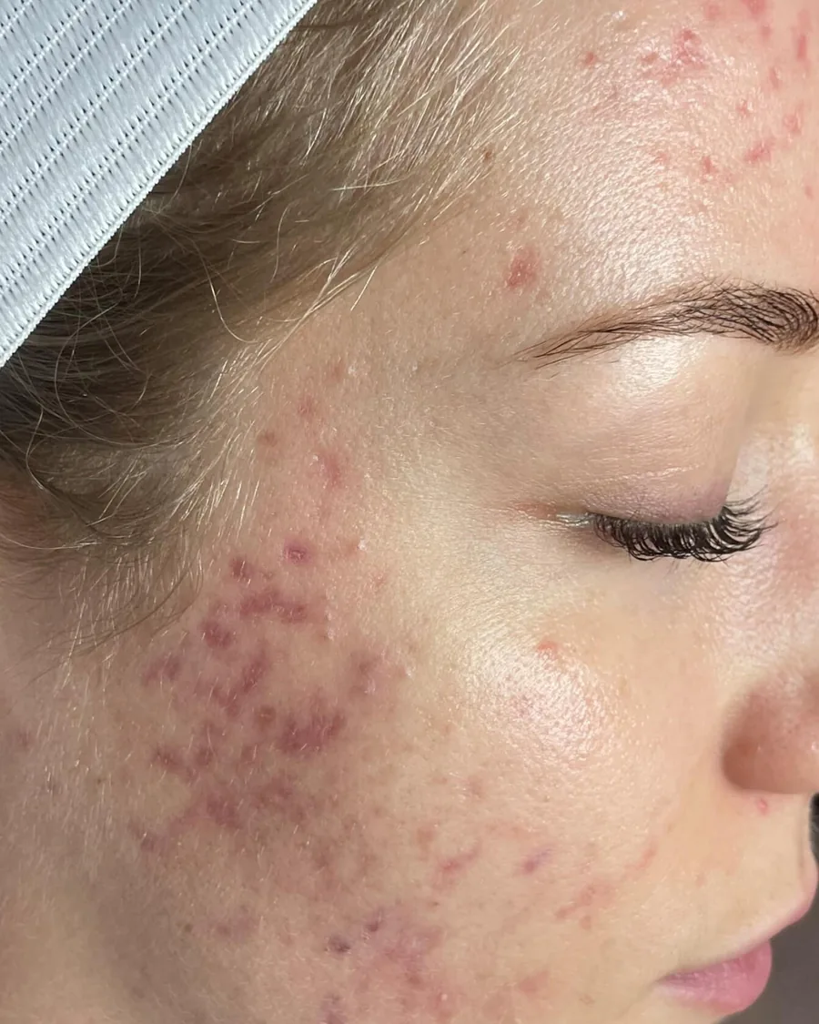 The cheek of a young woman with acne marks, before treatment