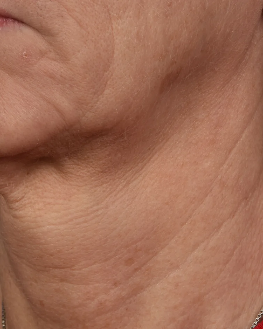 The side of a woman's neck and jaw, before treatment